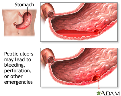 Ulcer emergencies Ulcer emergencies