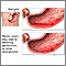 Ulcer emergencies Ulcer emergencies