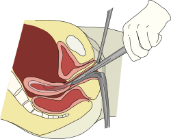 Dilation and curettage is performed to remove the firmly attached placental fragments, for the restoration of declined progesterone level to initiate lactation.