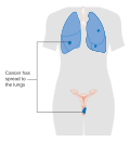 Stage 4B vaginal cancer