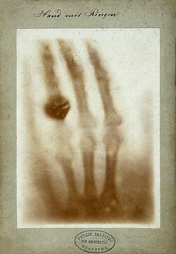 Röntgenfoto vom 22. Dezember 1895