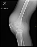 X-ray of Hemarthrosis