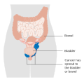 Stage 4A vaginal cancer