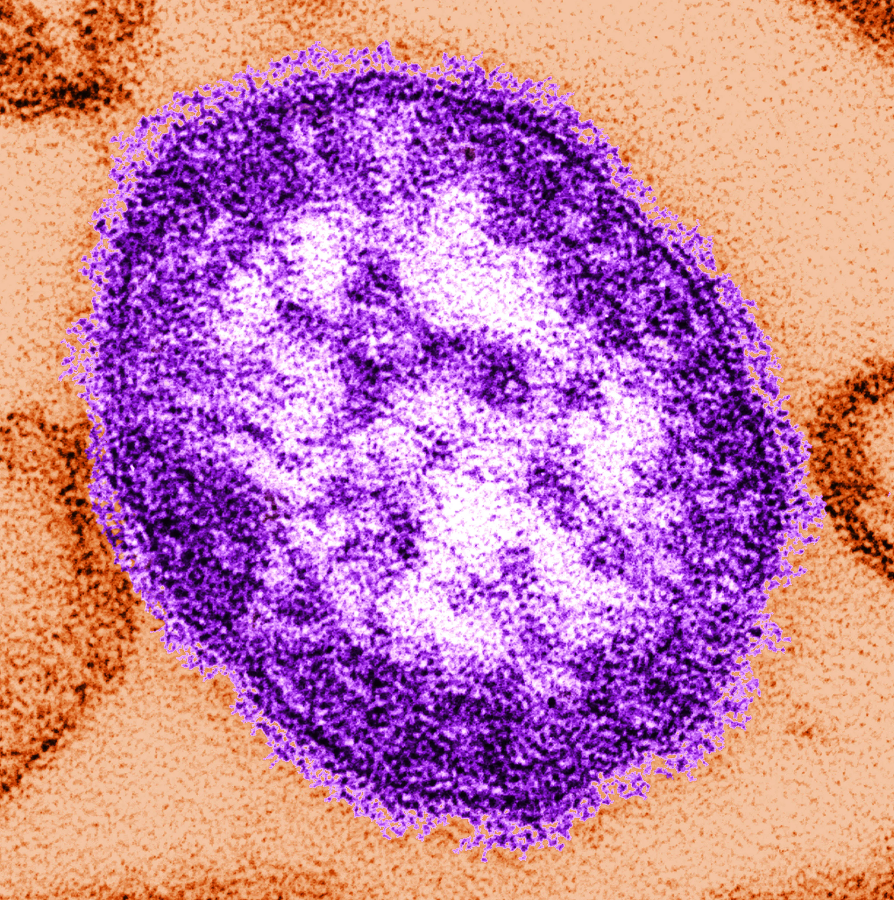Health officials investigating 5 probable measles cases in Rock County